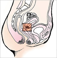 cancer-cervix-shortarticle